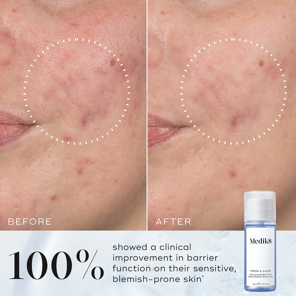 Side-by-side comparison labelled "Before" and "After" showing reduced redness and clearer skin inside a dotted circle. Text states "100% showed a clinical improvement in barrier function on their sensitive, blemish-prone skin*".