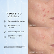 A split image showing a close-up of skin texture labelled "Before" and "After 4 Weeks," highlighting improvements. Text on the left lists benefits: "Reduced blemishes," "Improved skin texture," "Reduced pore size," and "Soothed visible redness."