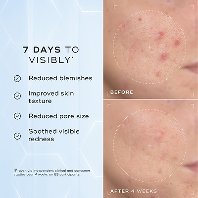 A split image showing a close-up of skin texture labelled "Before" and "After 4 Weeks," highlighting improvements. Text on the left lists benefits: "Reduced blemishes," "Improved skin texture," "Reduced pore size," and "Soothed visible redness."