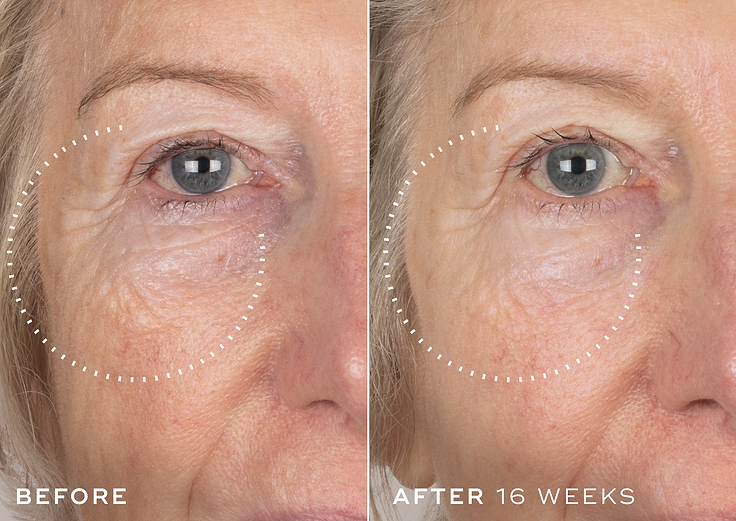 A side-by-side comparison illustrating a reduction in the appearance of fine lines and wrinkles around a person's eye. The left image, labelled ‘BEFORE’, shows more visible fine lines. The right image, labelled ‘AFTER 16 WEEKS’, displays visibly smoother skin in the same area. Both images highlight the targeted area with a white dotted circle