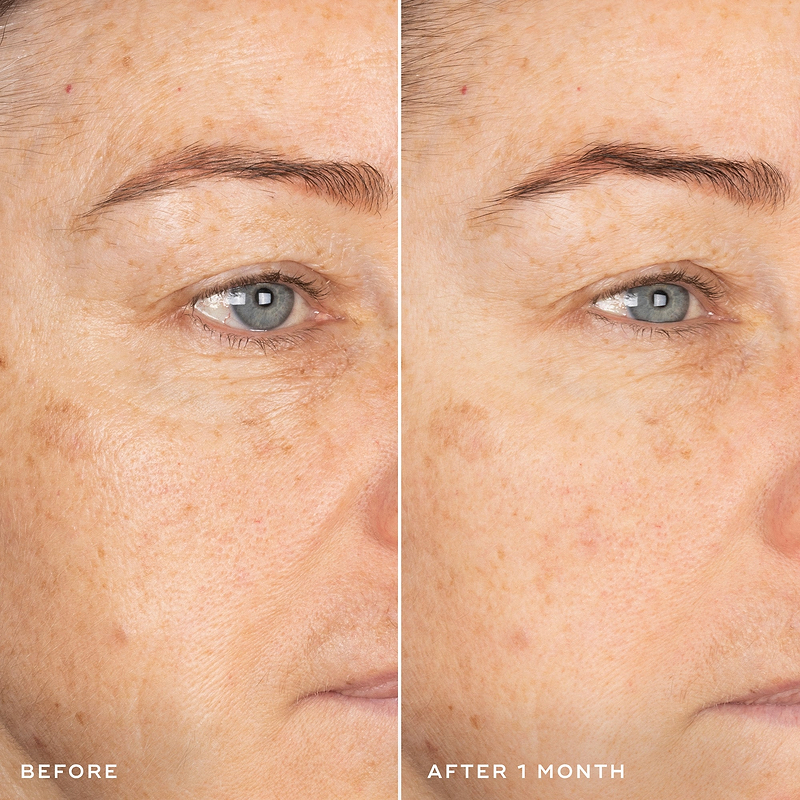 Exo-PDRN Prismatic+ Before & After 1 month