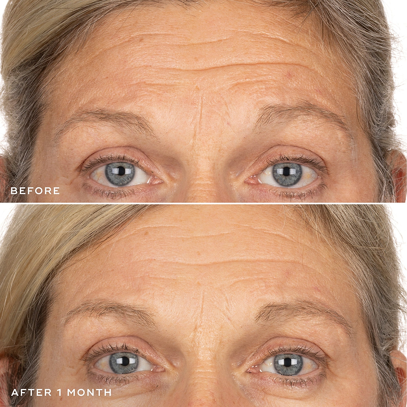 Exo-PDRN Prismatic+ Before & After 1 month