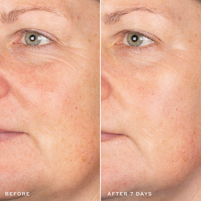 Exo-PDRN Prismatic+ Before & After 7 days